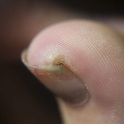 In growing toenail